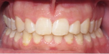 malocclusione di II classe risolto